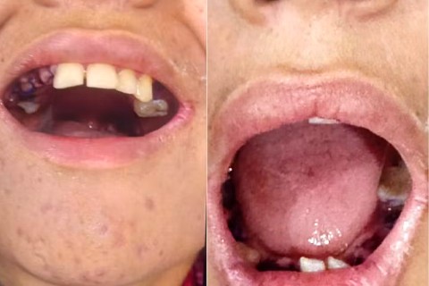 Governo e entidades investigam extração de 17 dentes em jovem autista sem consentimento